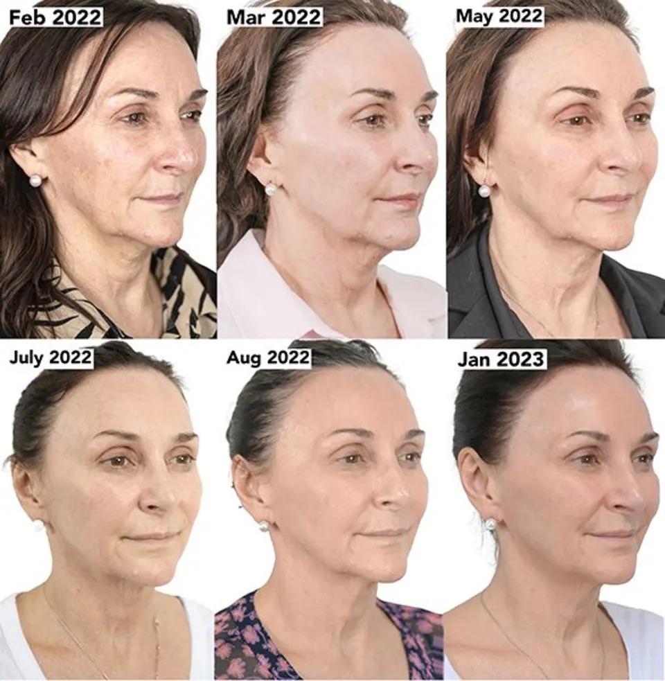 KN Medspa - NeoGen PSR - Before and After Photos